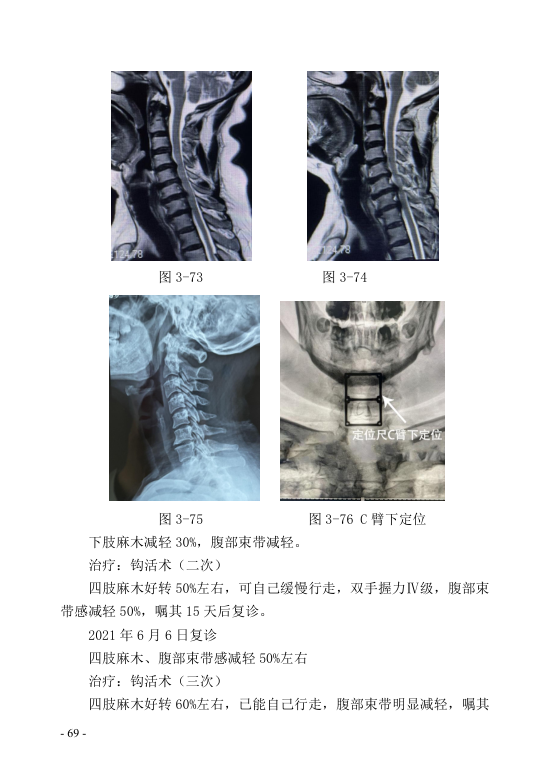 中医钩活术技术(自出）转出第80页.jpg